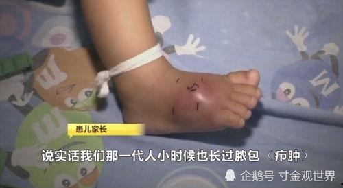 挤脓视频,专业医师亲授操作技巧与注意事项